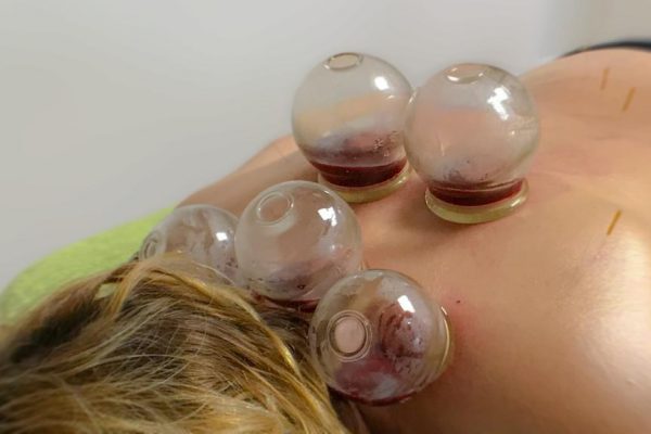 Schröpftherapie-Praxis-Dr-Huber-Hollenthon (1)